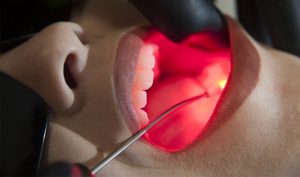Leia mais sobre o artigo Laserterapia na Odontologia: benefícios e limitações do uso de irradiation laser intravenous of blood (Ilib)