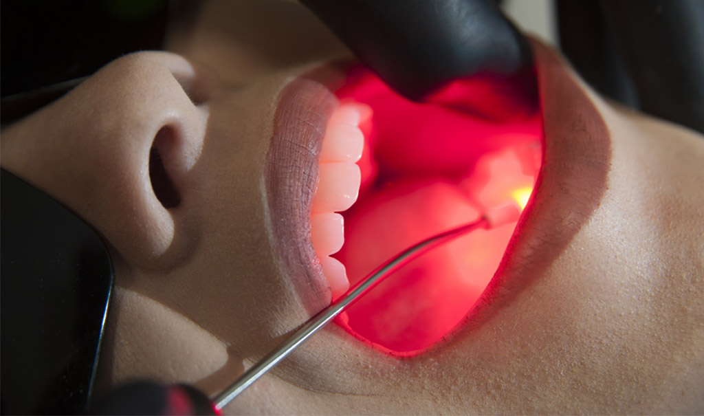 Você está visualizando atualmente Laserterapia na Odontologia: benefícios e limitações do uso de irradiation laser intravenous of blood (Ilib)