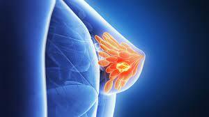 Você está visualizando atualmente Câncer de mama e quimioterapia vermelha: impacto no estado nutricional