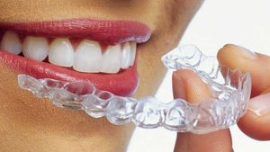 Leia mais sobre o artigo Ortodontia tecnológica. Fim da era dos braquetes?