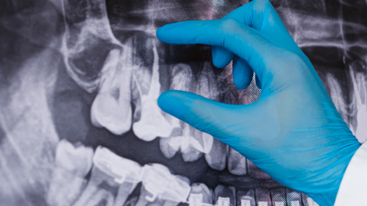 Você está visualizando atualmente A Odontologia legal e os estágios de mineralização dos terceiros molares para identificação da idade cronológica de um indivíduo