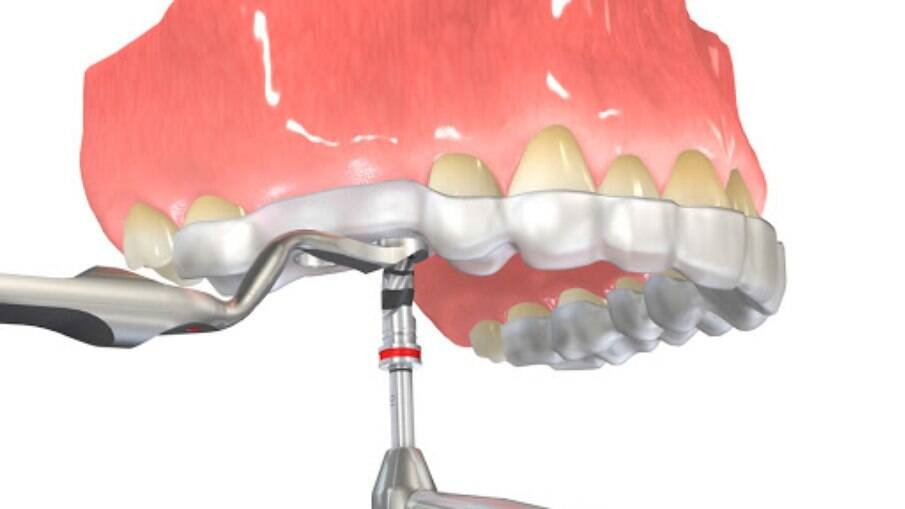 Leia mais sobre o artigo Osteoporose e alterações do tecido alveolar: saiba como proceder na clínica odontológica