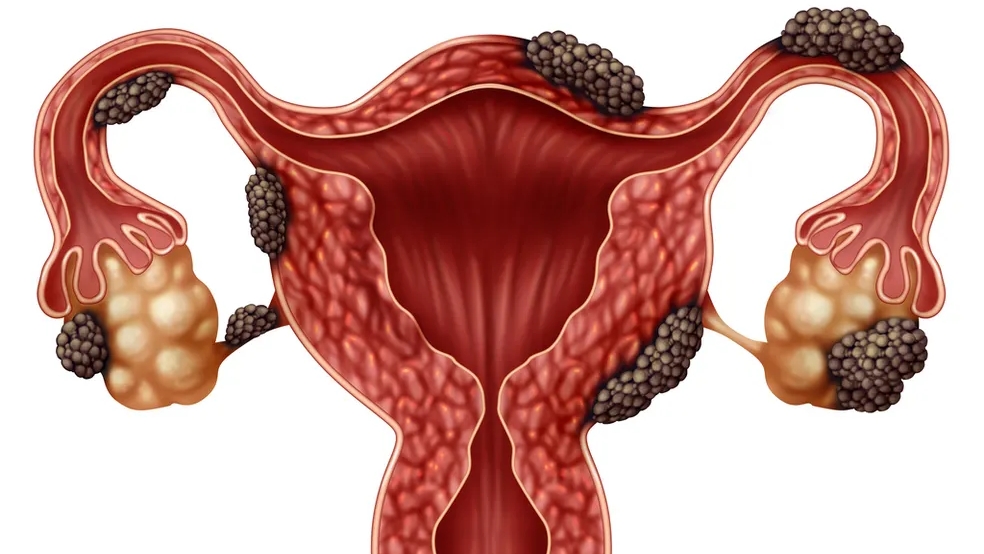 Leia mais sobre o artigo Endometriose: uma dor oculta