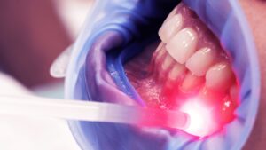 Leia mais sobre o artigo A laserterapia na prevenção e tratamento do herpes labial