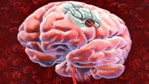Leia mais sobre o artigo Incapacidade funcional em indivíduos adultos jovens após acidente vascular cerebral: desafios da reabilitação para o retorno ao trabalho e vida produtiva