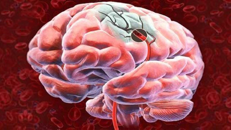 No momento, você está visualizando Incapacidade funcional em indivíduos adultos jovens após acidente vascular cerebral: desafios da reabilitação para o retorno ao trabalho e vida produtiva