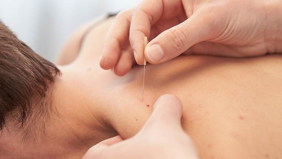 No momento, você está visualizando A importância do dry needling em pacientes com fibromialgia